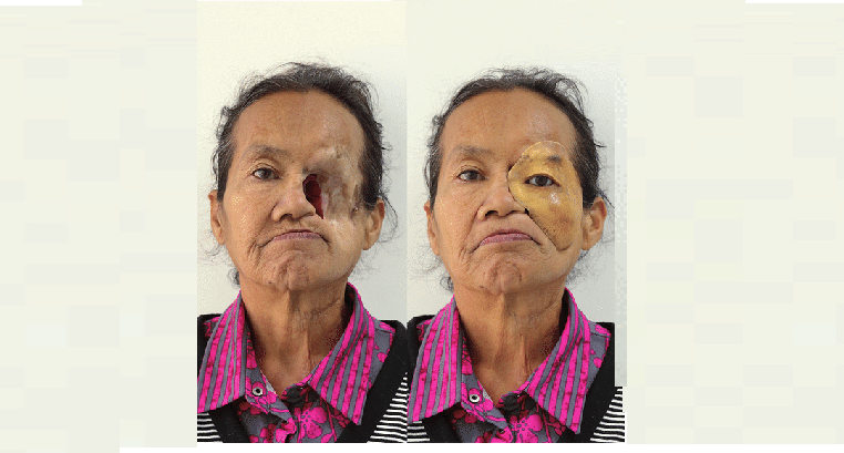 Partial Face Prosthesis