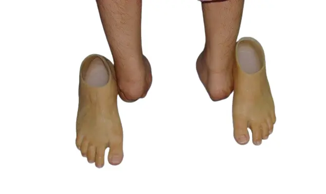 Partial Foot Prosthesis