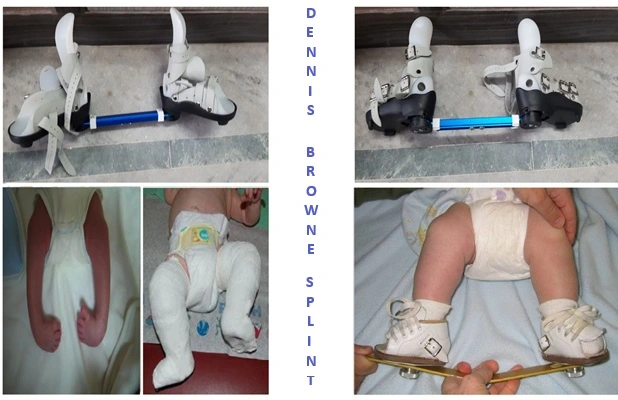 Dennis Browne Splint